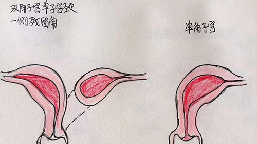 重度单角子宫保胎治验